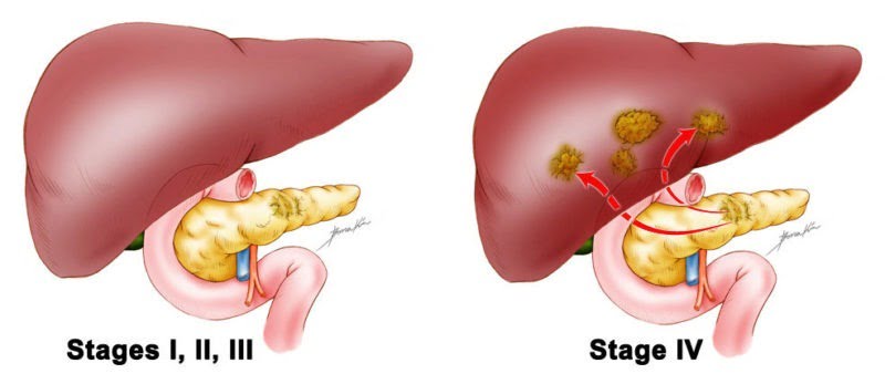 Pancreatic cancer